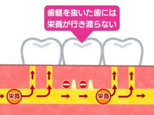 歯髄を取った歯
