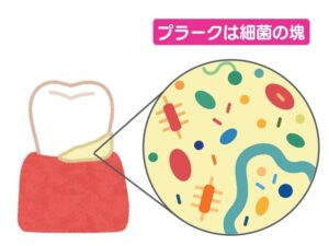 プラークの付いた歯