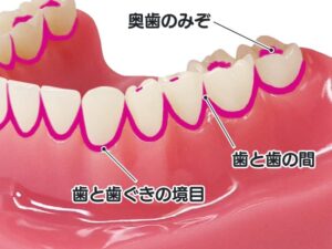 歯垢