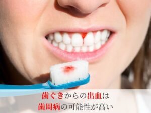 歯茎からの出血