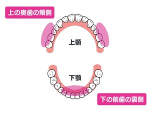 歯石