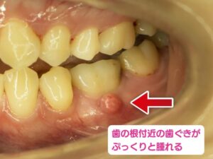 膿が溜まった歯茎