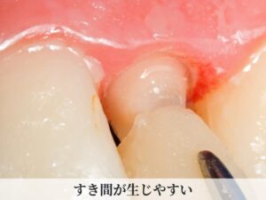 歯の隙間