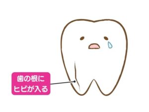 ヒビが入った歯
