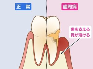 歯周病で骨が溶ける様子