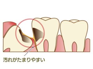 親知らずに汚れが溜まった様子