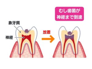 神経まで到達した虫歯