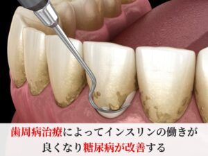 歯周病治療
