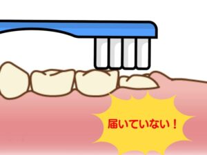 歯ブラシが届かない様子