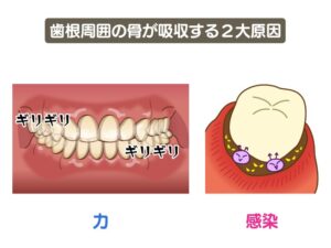 歯根周囲の骨が吸収する2大原因