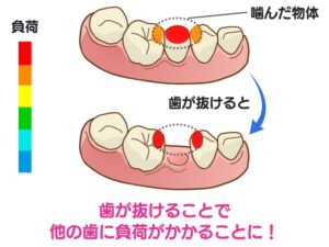 奥歯を失ったときの影響