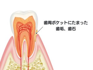 歯周ポケット