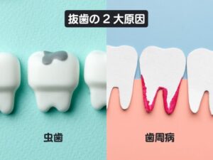 抜歯の2台原因