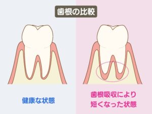 歯根吸収した歯根と健康な歯根の比較