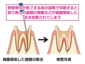 治療を中断した根管