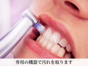 歯のクリーニング