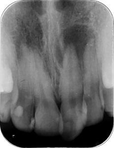 歯根嚢胞のレントゲン