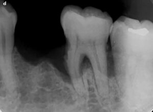 重度歯周病のレントゲン