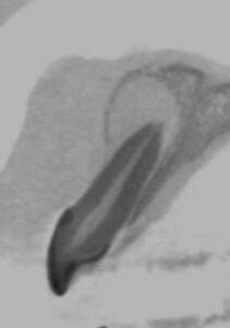 歯根嚢胞のレントゲン②