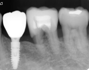 インプラント治療後のレントゲン
