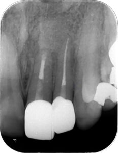 歯根嚢胞治療後のレントゲン