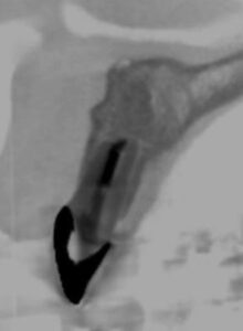 歯根嚢胞治療後のレントゲン②