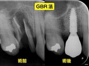 GBR法のレントゲン