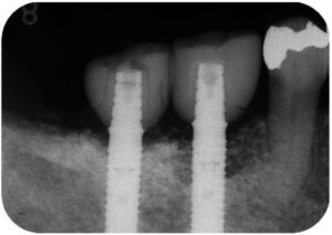 インプラントのレントゲン