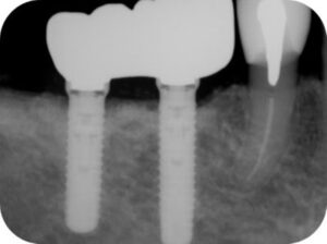 8年経過後のレントゲン