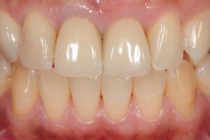 治療後の歯