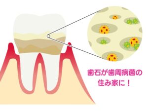 歯石の原因