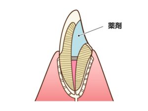 ウォーキングブリーチ