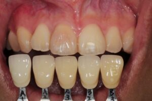 ウォーキングブリーチのビフォー