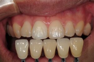 ウォーキングブリーチのアフター