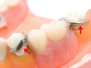 金属バネが目立つ様子