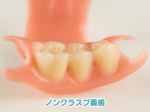 ノンクラスプ義歯