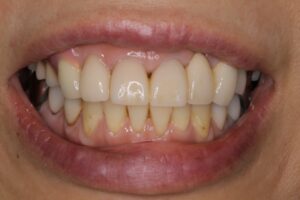 義歯を装着した口