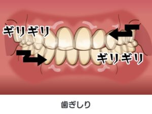歯ぎしり