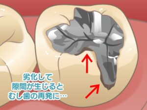 二次むし歯のイメージ