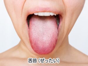 口臭の原因となる舌苔と呼ばれる舌の汚れ