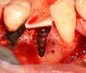 インプラント埋入直後