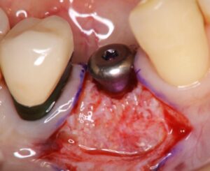 インプラント埋入・骨造成手術から6か月後