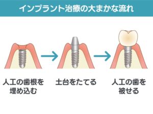 インプラント治療の大まかな流れ