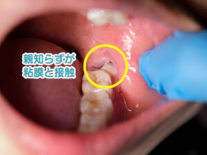 親知らずが粘膜と接触してしまっている