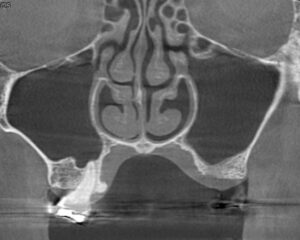 治療後のレントゲン