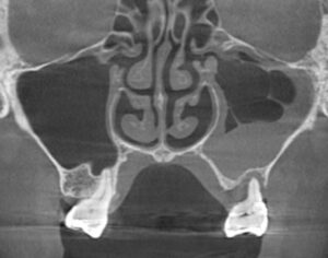 副鼻腔炎のレントゲン