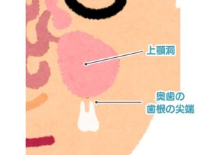 歯が原因で起こる上顎洞炎