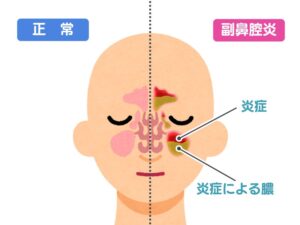 副鼻腔炎のメカニズム
