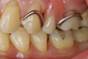 金属バネがある入れ歯（クラスプ義歯）