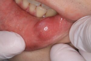 粘液嚢胞のできた唇